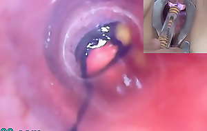 Full-grown Chick Peehole Endoscope Camera involving Bladder with Natter on